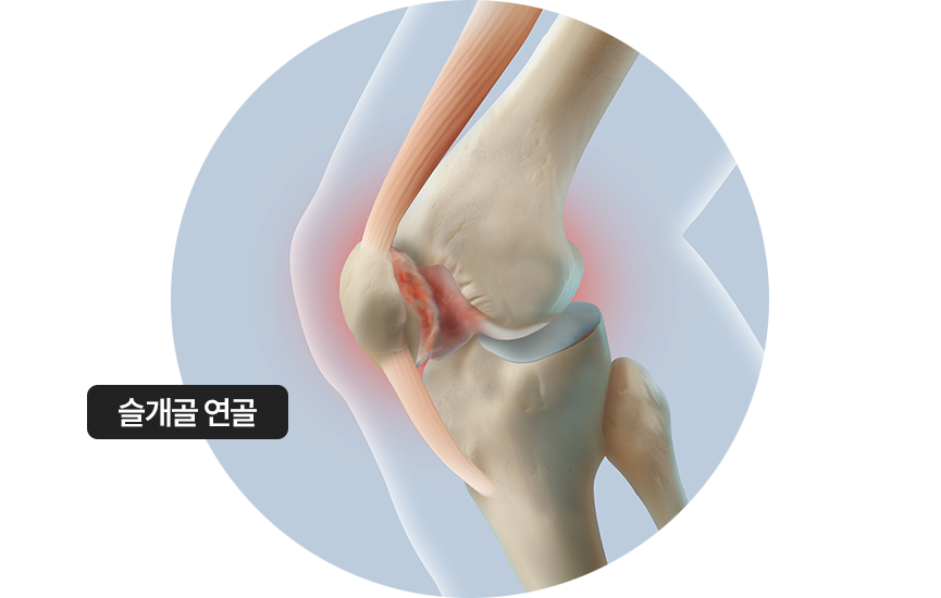 슬개골 연골